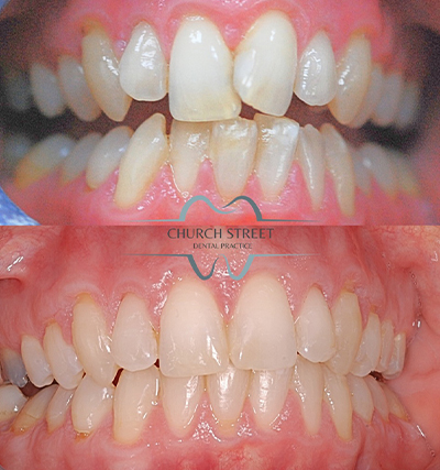 Clear Aligners