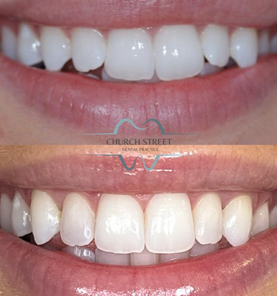 Clear Aligners
